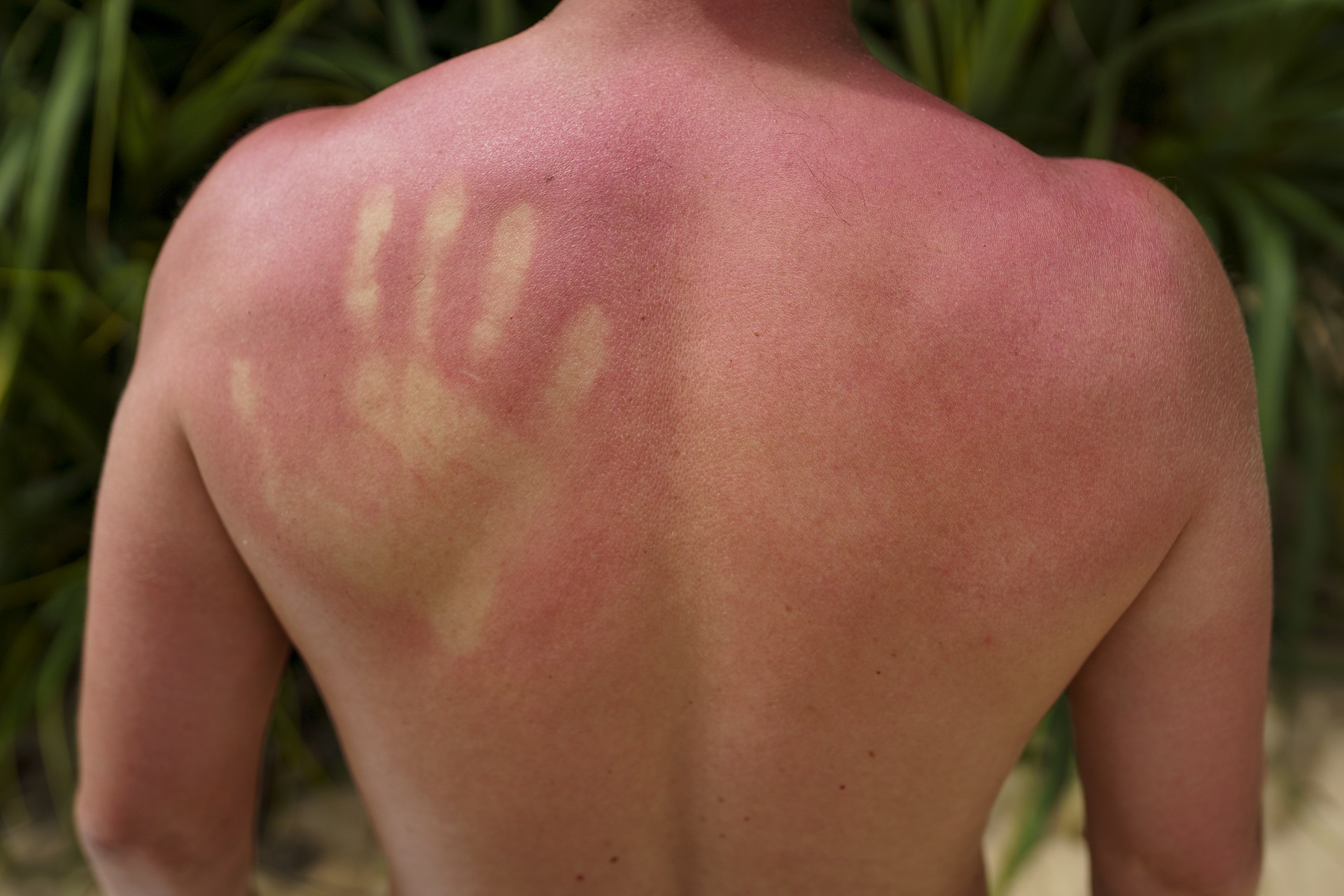 Sunburn treatment measures tips